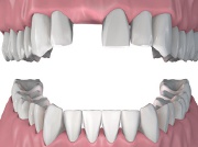 Brak pojedynczego zęba