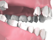 Ubytek trzech zębów w szczęce